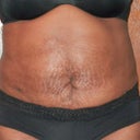 front view 17 days post op.  I am seeing a difference..