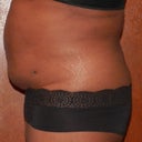 side view 17days post op.  Flanks look good and no hang time.. yay!!!  still swollen.. and looking forward to the weeks ahead..