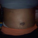1 week post op