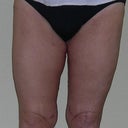Here I am at 13 day postop. Drains out. The bow-leg/knock knee look is legacy of many yrs of morbid obesity & severe osteoarthitis in knees, so that is something I'll live with. Can't believe the lack of all that excess skin - so happy it is GONE!