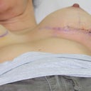 my wound day 7 ( sutures are still in and its now day 10, i am suspossed to have them removed day 21, but i think this is a long time for them to stay in , i have emialed the surgeon to ask if i can have the removed earlier)