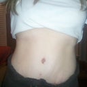 Front view, hiding scar...doc says to expect swelling and scar to get better and better each month and to look for the final results after a year of recovery...