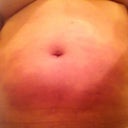 Day 1 abdomen. Felt like I was burned.