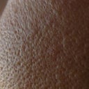 Massive pores and bumps all over my skin. I never had anything like this before.
