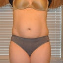 Before - front