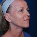 Before Procedure, No makeup facial or eye