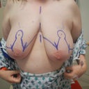Marked up for surgery