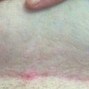 Ouch! Ingrown on incision line :(