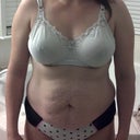 Before Pic.  Taken Day of Surgery.  Can't believe how bad it looks!