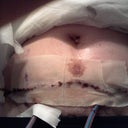 front with drains sorry about pubes