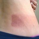 bruising 3 days after treatment 