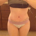 3 weeks postop