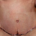 2 days post-op