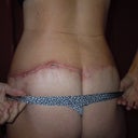 After 4 weeks post op