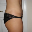 PO 3 months.  Side View of Scar.  The scar does not go past my hip bone.
