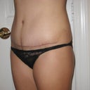 PO 3 months.  Another Side View of the Scar.