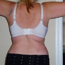 DAY 34..POST OP..WISH I DID MY BRA BULGE
