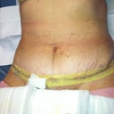 Day 2 Post Op