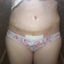 I tend to get more swollen on the top and on the bottom, and the center of my tummy not so much, I mean it's all swollen just more so on top and bottom. My incision looks higher on the one side but Im just super swollen on that end of the incision for some reason??