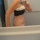 See how swollen in the back. I look like a hunch back! LOL