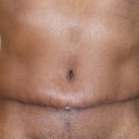 Four Weeks After Surgery