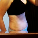 23 days post op. Still swollen but going down after losing 5 pounds.