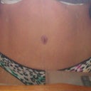 10 1/2 weeks out from the body lift
