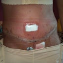 front view, still swollen
