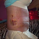 bruising from lipo