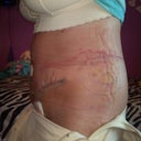 left side isnt as bruised but i have more purple stretchies by my incision