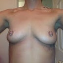 Before front view.. Left breast slightly larger.
