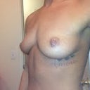 Before. Left side oblique