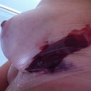 AFTER EXPLANT - SIDE VIEW WITH BLOOD BUBBLE