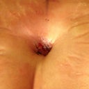 PO day 1 belly button