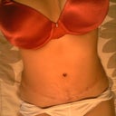 5 weeks post op