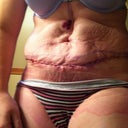 First day post op