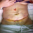 3 days post op