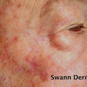 Mohs Surgery