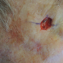 Mohs Surgery
