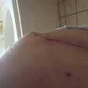 Weird incision...revision???