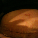 12 days PO bad swelling i think pic might b upside down