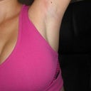 6 months post op scar