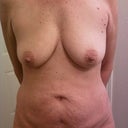 Day before surgery. 1/18/12