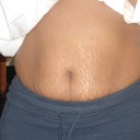 Pre-op Front View