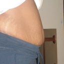 Pre-op side view