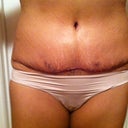No drains!  yep there's swelling.  minimal pain. POD 3