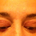Scar line