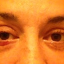 Eyes off swelling??