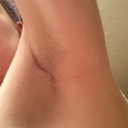 day 25 left incision