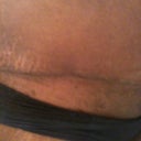 Scar @ 4 wks (right side)